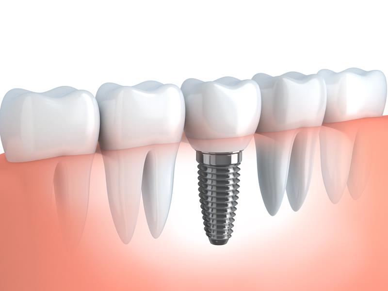 Dental Implants in Diamond Bar, CA