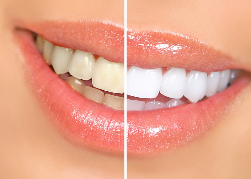 teeth whitening services in Diamond Bar, CA