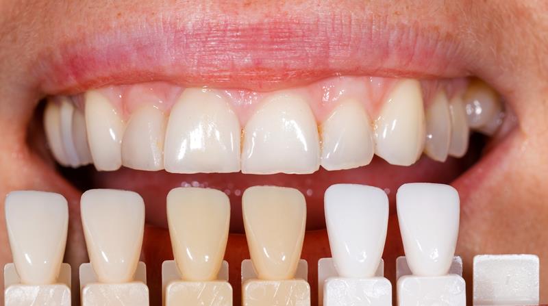 Veneers in Diamond Bar, CA